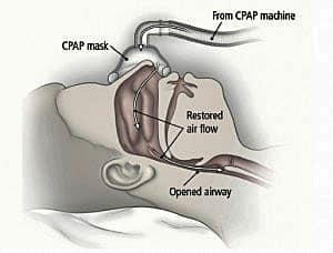 Sleep Apnea - RemSleep