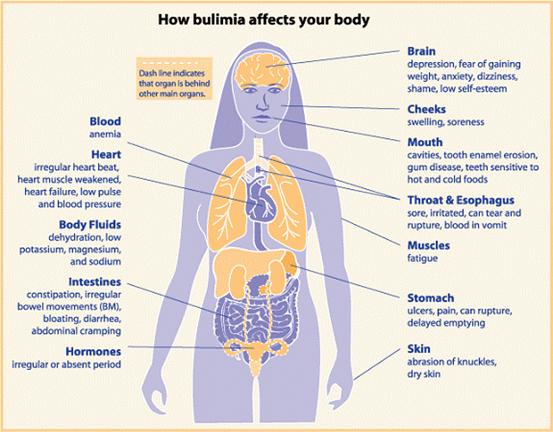 How bulimia affects your body