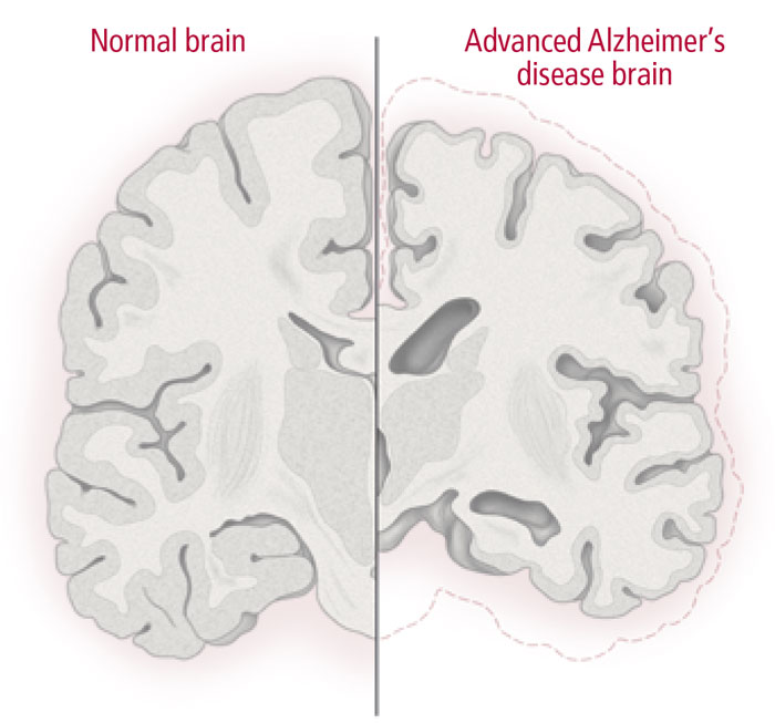 Normal vs Alzheimer's brain